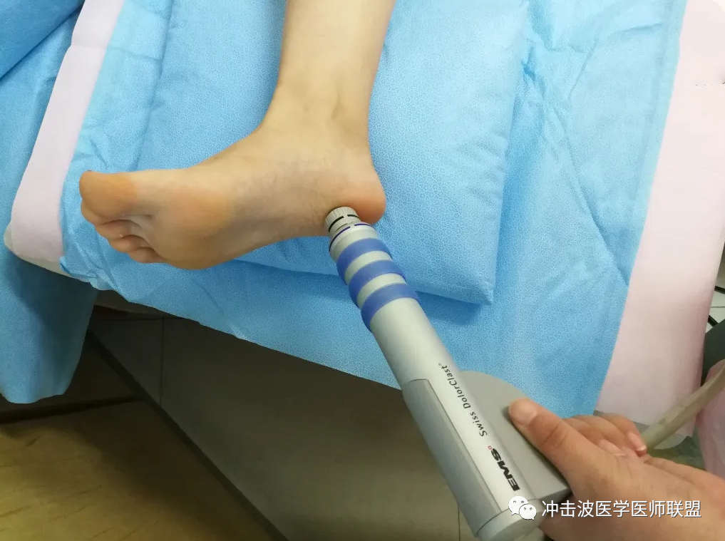 跖腱膜炎 足跟痛 应用体外冲击波该如何治疗